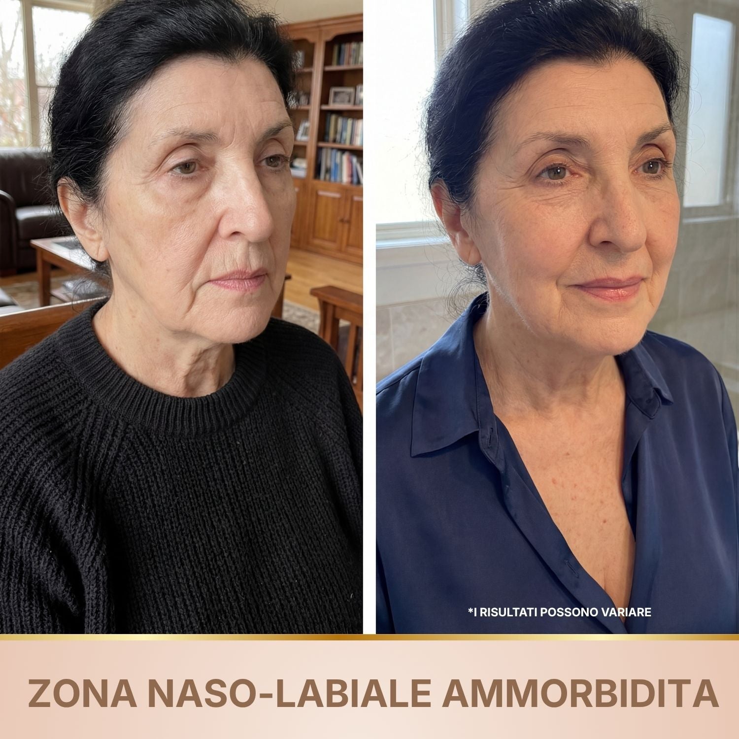 Siero antirughe BioChroma prima e dopo rughe di espressione solchi naso-labiali ammorbiditi
