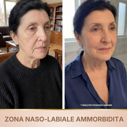 Siero antirughe BioChroma prima e dopo rughe di espressione solchi naso-labiali ammorbiditi
